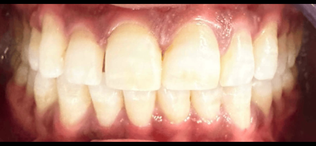 After image