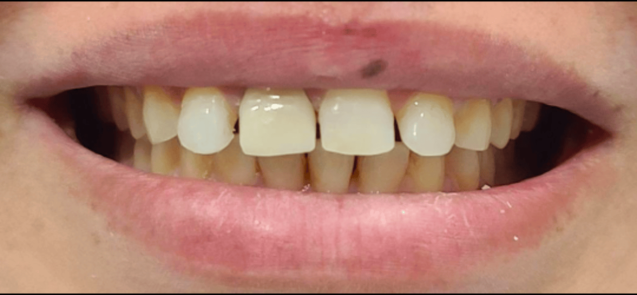 After image