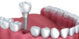 affordable implants near me | dental avenue hospital