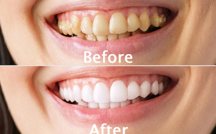 teeth whitening near me | dental avenue hospital