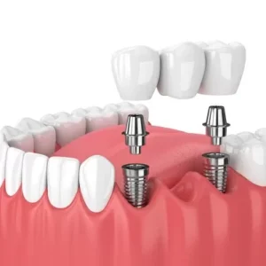 Tooth implant price in Pakistan at Dental Avenue Hospital – offering affordable dental implant treatment, single tooth replacement with titanium implants, painless dental procedures by the best implant dentist in Lahore. Get long-lasting tooth restoration and missing tooth solutions from a leading dental implant clinic in Pakistan.