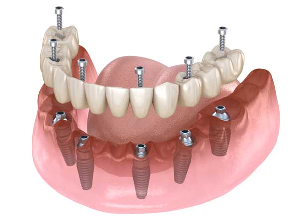 Fixed implant dentures cost in Lahore – Dental Avenue Hospital offering durable and natural-looking dental implant dentures