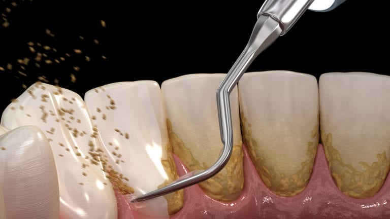 Best Dental Cleaning Services in Lahore at Dental Avenue Hospital – Professional Teeth Cleaning & Oral Hygiene Care