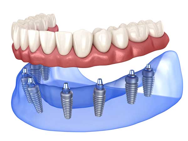 What are dental implants – Dental Avenue Hospital Lahore explanation with benefits and procedure
