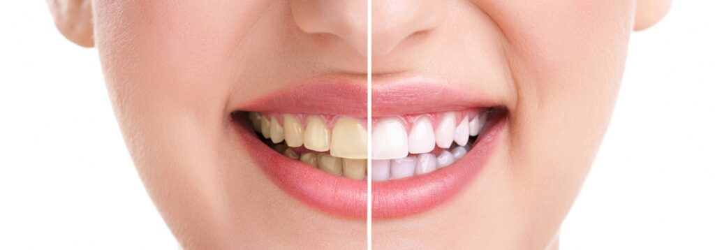 Teeth cleaning in Lahore at Dental Avenue Hospital - professional dental hygiene and periodontics care