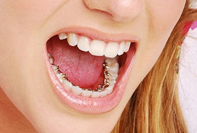 Incognito lingual braces treatment at Dental Avenue Hospital Lahore – best orthodontic braces near me for invisible teeth alignment.