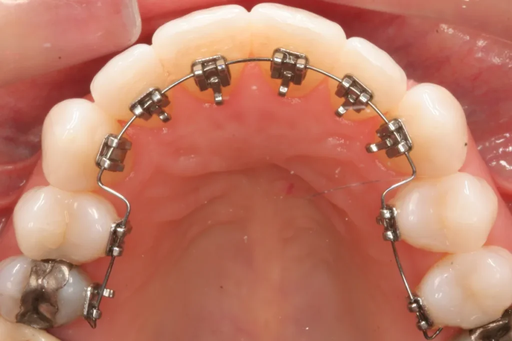braces for teeth | dental avenue hospital