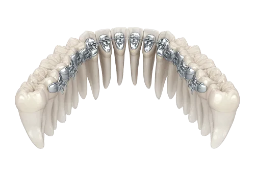 types of braces | dental avenue hospital