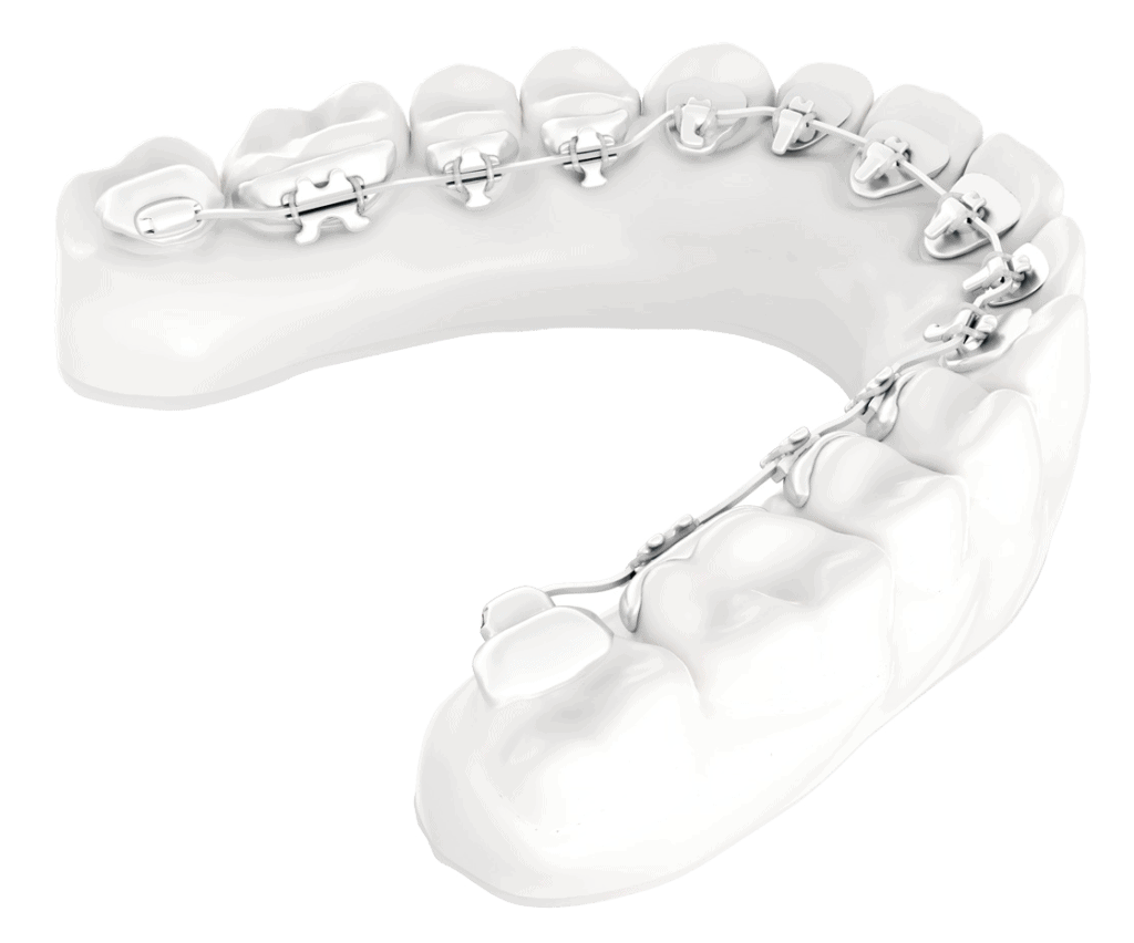 Lingual Braces price in pakistan | dental avenue hospital