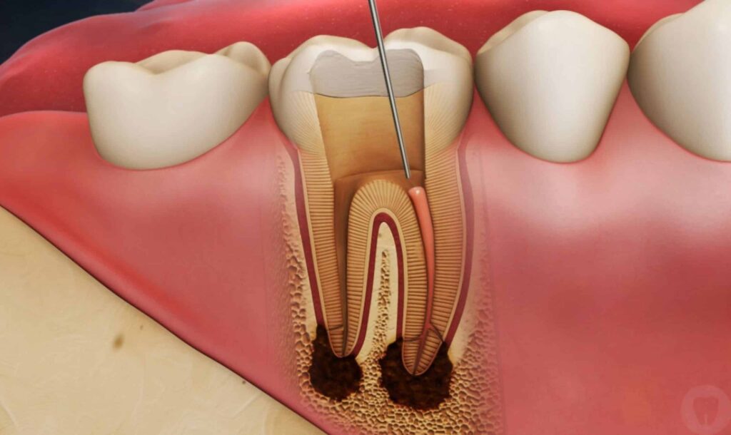 Best dental surgeon for root canal in Lahore – Expert painless RCT at Dental Avenue Hospital with advanced dental care and experienced specialists