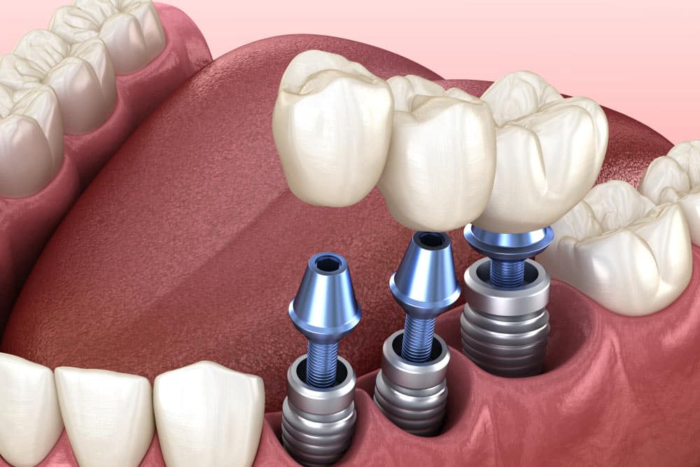 Digital Implantology- The latest technology in Dental Implants by Dental Avenue Hospital Lahore