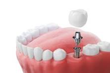 Modern dental implant procedure at Dental Avenue Hospital Lahore, the best dental hospital for advanced tooth replacement and oral care in Lahore