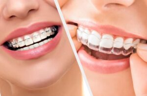 Aligners for teeth price in Pakistan – Affordable clear braces at Dental Avenue Hospital Lahore