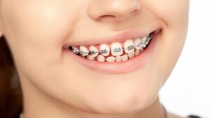 Metal braces at Dental Avenue Hospital in Lahore – affordable orthodontic treatment