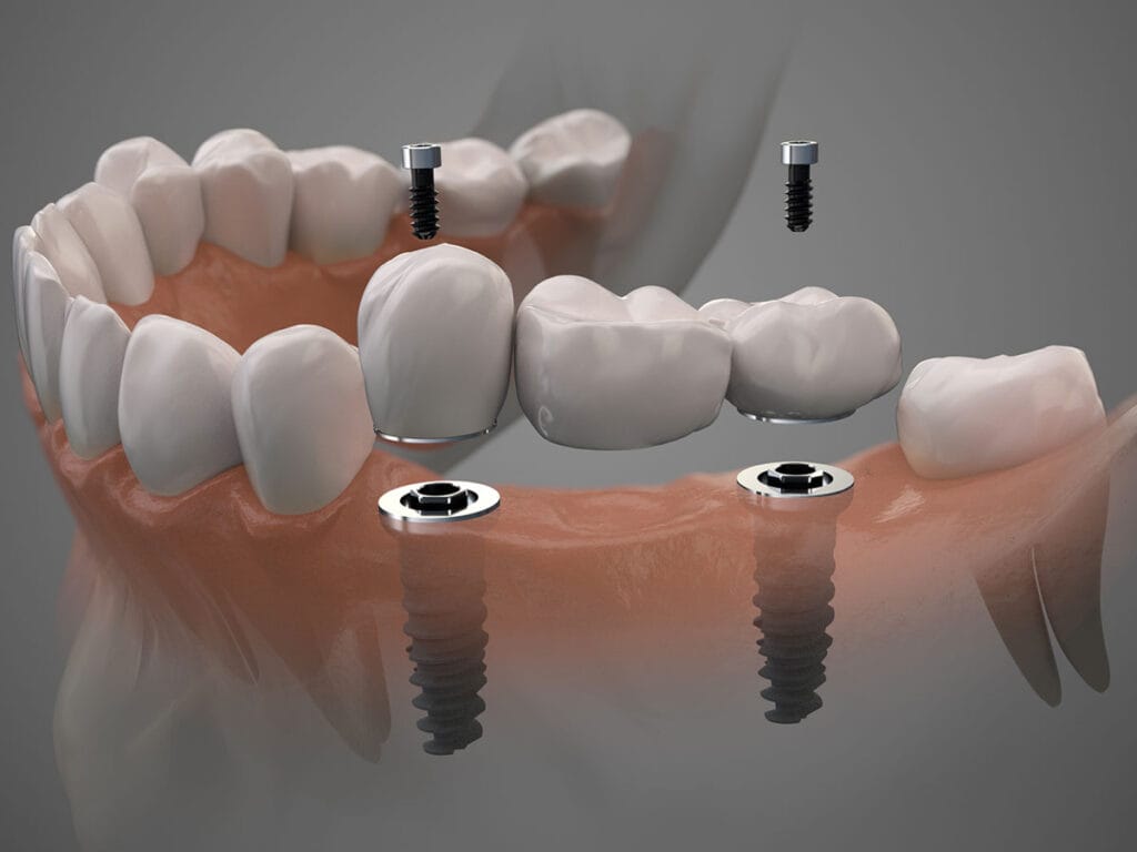Dental Implants in Lahore for Missing Teeth – Dental Avenue Hospital Lahore offering advanced implant dentistry and permanent tooth replacement solutions.