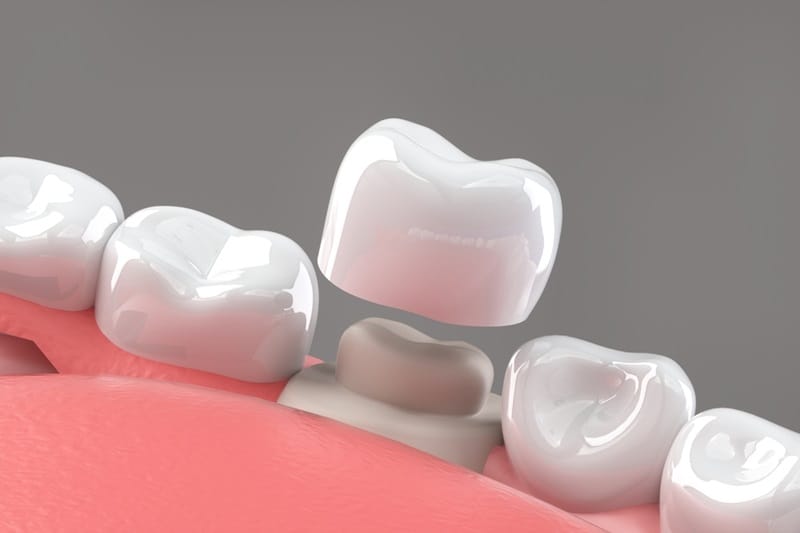 Artificial Teeth Price in Lahore | Dental Avenue Hospital Lahore