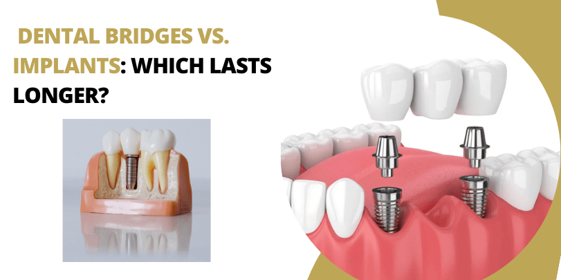 Dental Bridges vs. Implants in Lahore – Expert Tooth Replacement Solutions at Dental Avenue Hospital