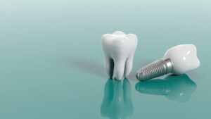 Dental implants near me – permanent tooth replacement at Dental Avenue Hospital Lahore