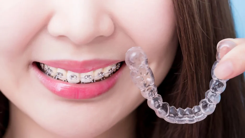 Affects Invisible Aligners Price in Lahore – Dental Avenue Hospital | Best Clear Aligners & Invisible Braces Treatment in Lahore
