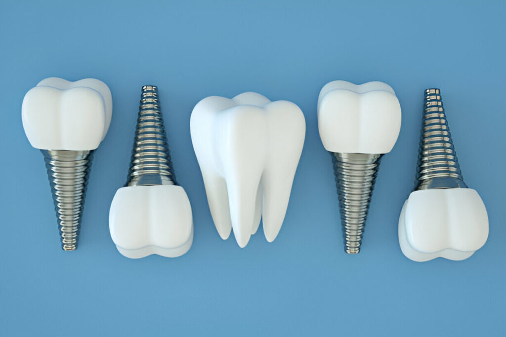 Dental Implants in Lahore by Dental Avenue Hospital – Best Dental Clinic for Implant Surgery