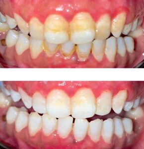 Professional teeth whitening in Lahore – Affordable price by Best Dental Clinic, Dental Avenue Hospital Lahore