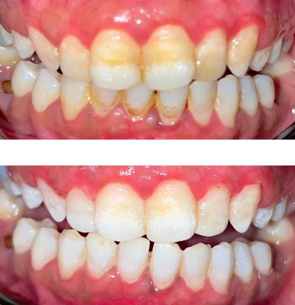 Professional teeth whitening in Lahore – Affordable price by Best Dental Clinic, Dental Avenue Hospital Lahore