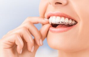 Clear aligners in Lahore for comfortable teeth straightening – Dental Avenue Hospital