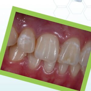 Fluorosis teeth stains treatment at Dental Avenue Hospital