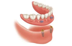 Different types of dentures for tooth replacement at Dental Avenue Hospital