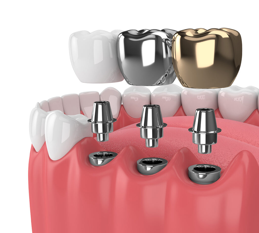 Types of Dental Implants at Dental Avenue Hospital Lahore