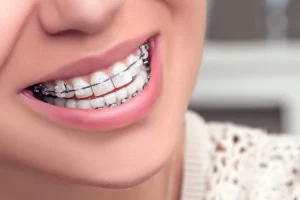 Invisible braces treatment at Dental Avenue Hospital in Lahore