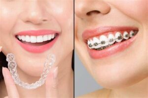 Invisible braces treatment cost in Lahore at Dental Avenue Hospital