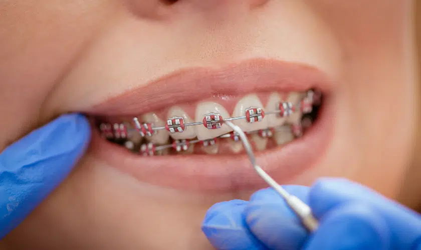Orthodontic metal braces treatment at Dental Avenue Hospital Lahore