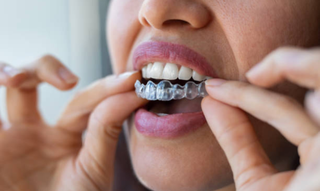 Invisible Braces cost factors at Dental Avenue Hospital Lahore – transparent aligners pricing guide