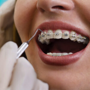 Price of fixed metal braces in Lahore at Dental Avenue Hospital