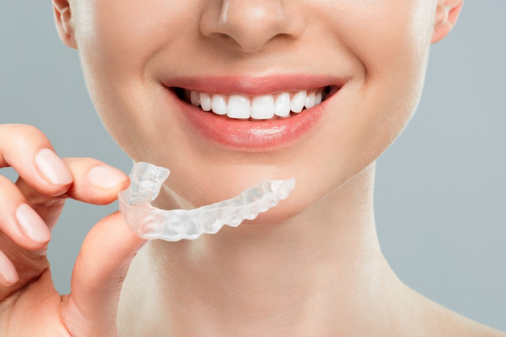 Step-by-Step Journey: What to Expect with Clear Aligners
