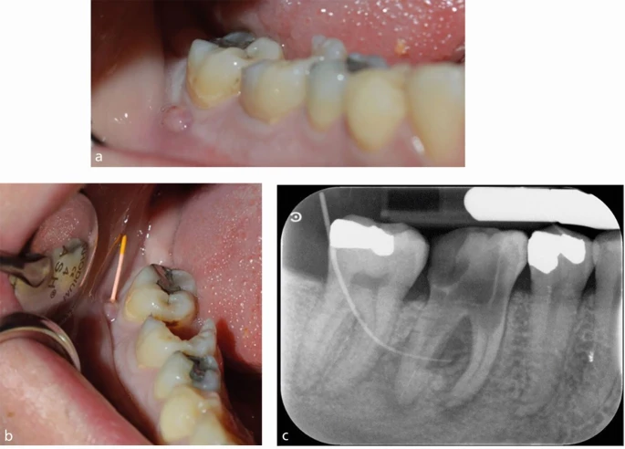What Is Endodontics and How Can It Save Your Teeth in Lahore?