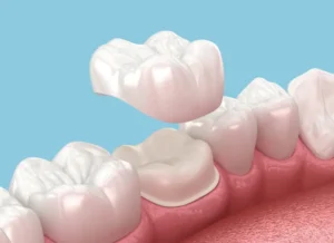 types of dental crowns in lahore