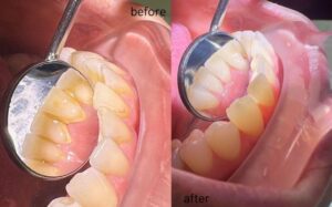 dental scalling and polishing in lahore