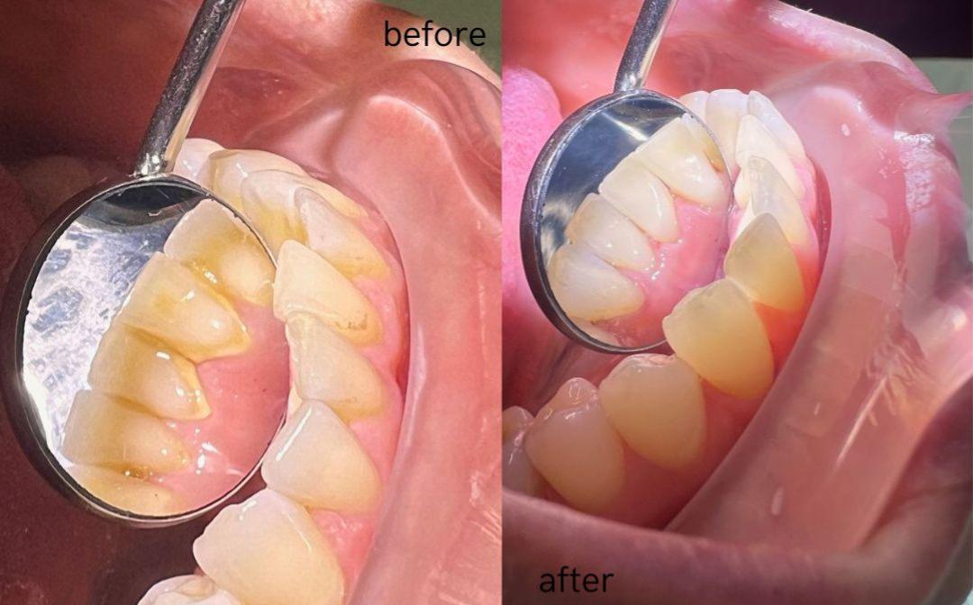 dental scalling and polishing in lahore