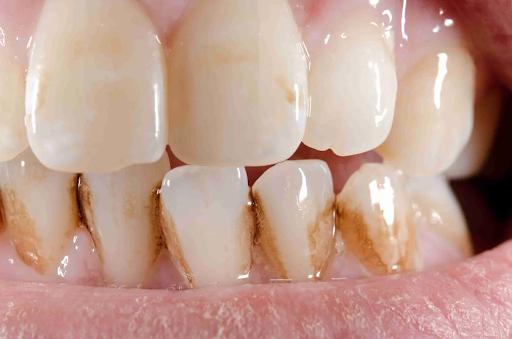 Dark Spots or Stains on Teeth