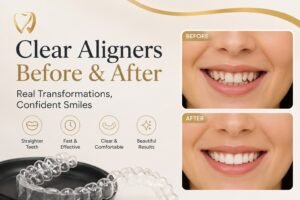 Side-by-side comparison of teeth before and after clear aligner treatment showing correction of crooked teeth and crowding.