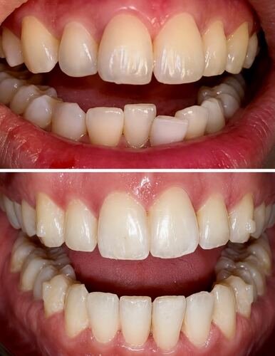 After photo of Sobia's smile following clear aligner treatment
