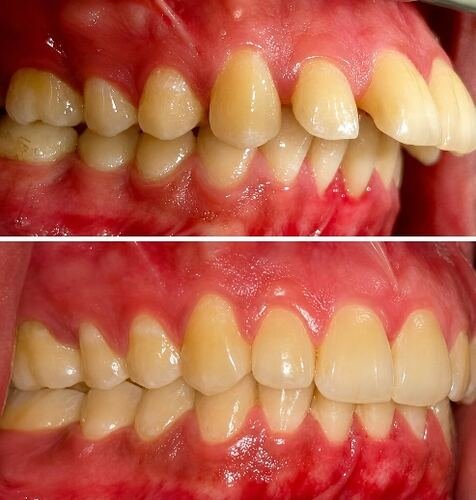 Before and after photo of Qousia's smile transformation with clear aligners