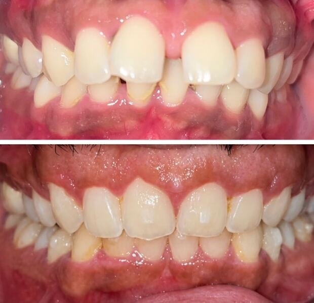 Before and after smile transformation for Eman with clear aligners