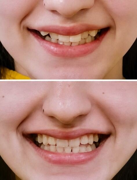 Before and after smile transformation for Essa with clear aligners