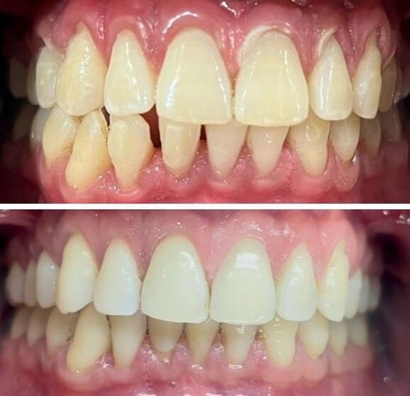 Before and after smile transformation for Farukh Batool with clear aligners