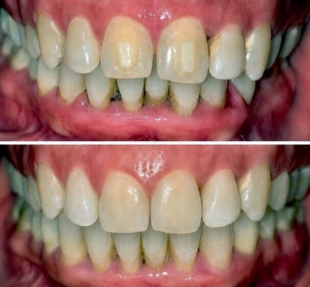Before and after smile transformation for Saud with clear aligners