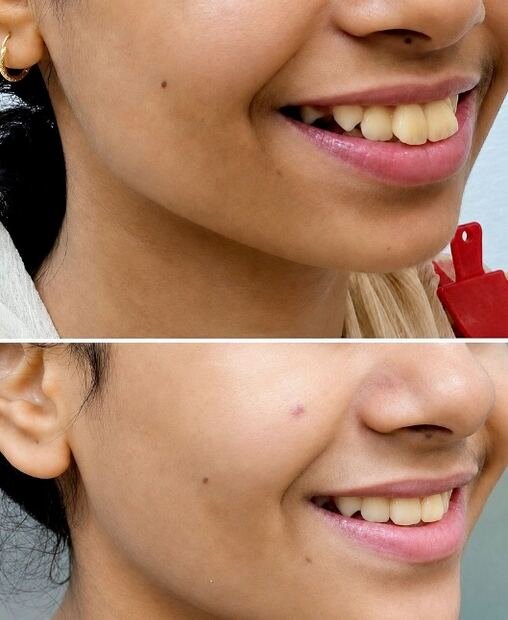Before and after smile transformation for Sunita with clear aligners