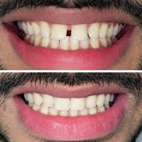 Before and after smile transformation for Umaima with clear aligners